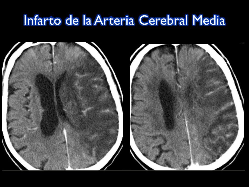 Infarto de la Arteria Cerebral Media