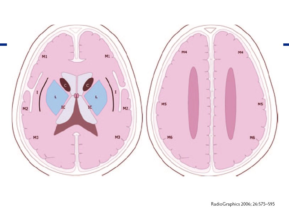 Figure 6. Schematic shows the 10 regions of the MCA distribution, each of which accounts for one point in the ASPECTS system: M1, M2, M3, M4, M5, M6, the caudate nucleus (C), the lentiform nucleus (L), the internal capsule (IC), and the insular cortex (I). For each area involved in ischemia depicted at unenhanced CT, one point is subtracted from the total score of 10.