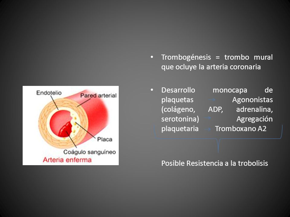 Trombogénesis = trombo mural que ocluye la arteria coronaria