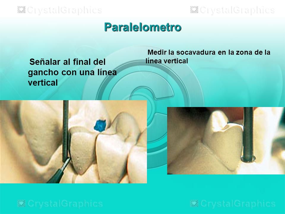 Paralelometro Señalar al final del gancho con una línea vertical