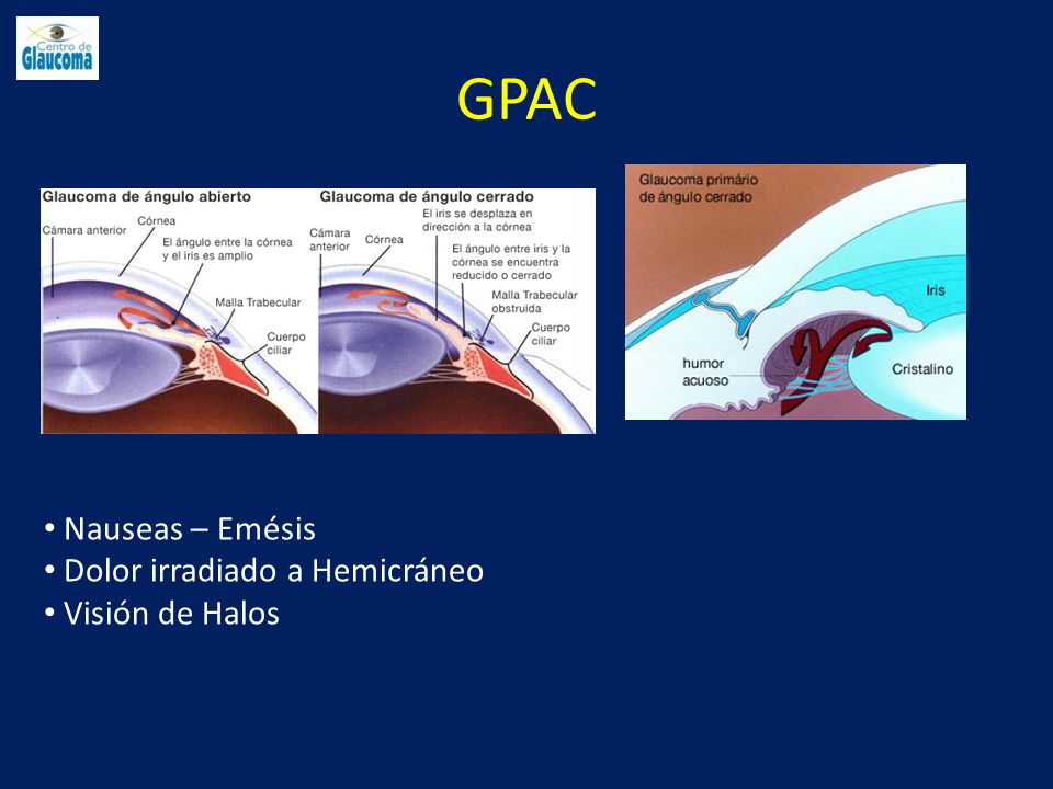 GPAC Nauseas – Emésis Dolor irradiado a Hemicráneo Visión de Halos
