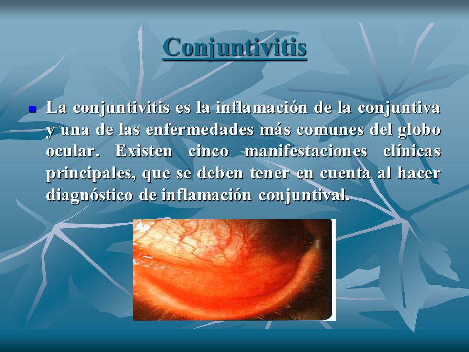 Conjuntivitis
