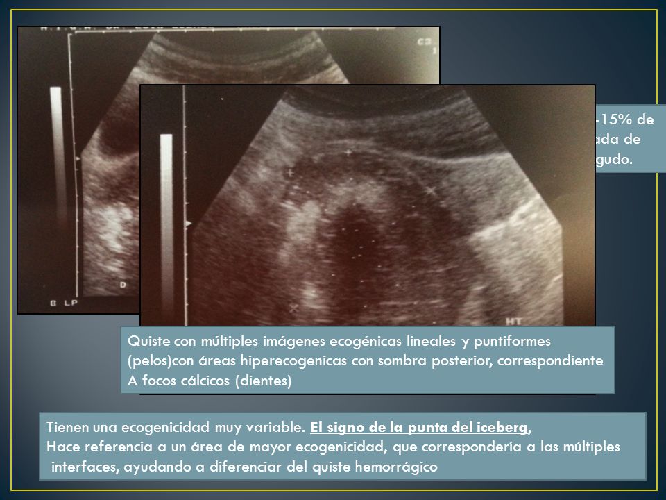 Los teratomas o quistes dermoides, son neoplasias benignas, con una frecuencia 10-15% de