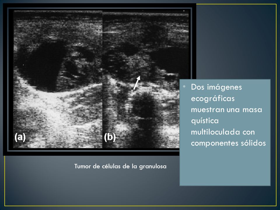 Dos imágenes ecográficas muestran una masa quística multiloculada con componentes sólidos