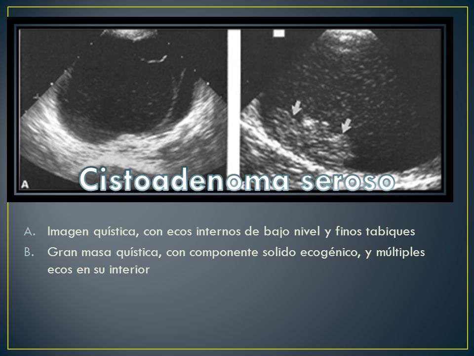 Cistoadenoma seroso Imagen quística, con ecos internos de bajo nivel y finos tabiques.