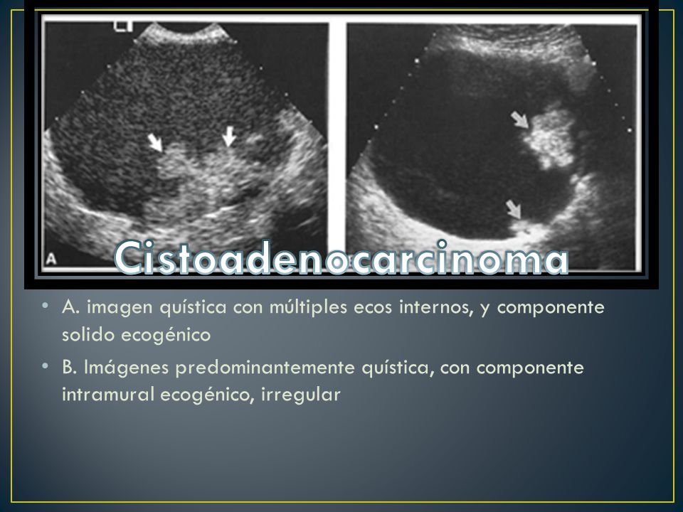 Cistoadenocarcinoma A. imagen quística con múltiples ecos internos, y componente solido ecogénico.