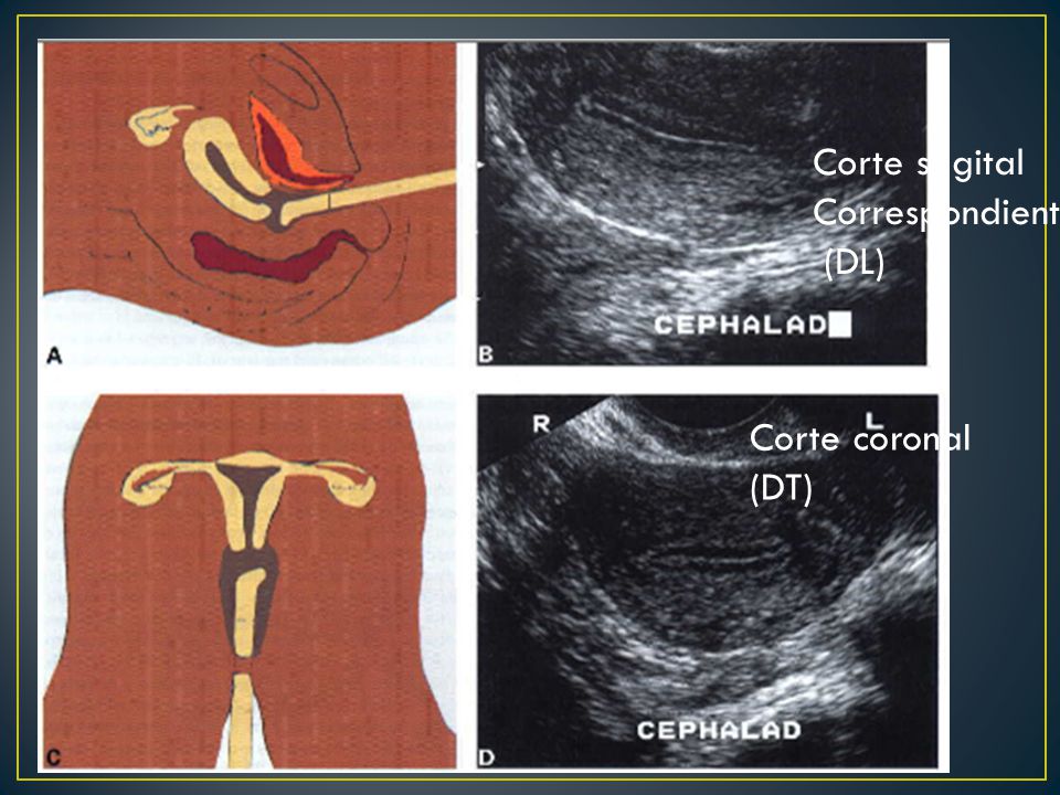 Corte sagital Correspondiente (DL) Corte coronal (DT)
