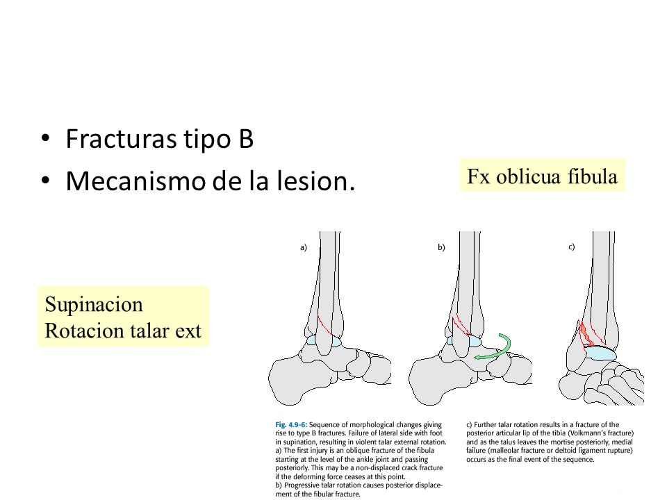 Fracturas tipo B Mecanismo de la lesion. Fx oblicua fibula Supinacion