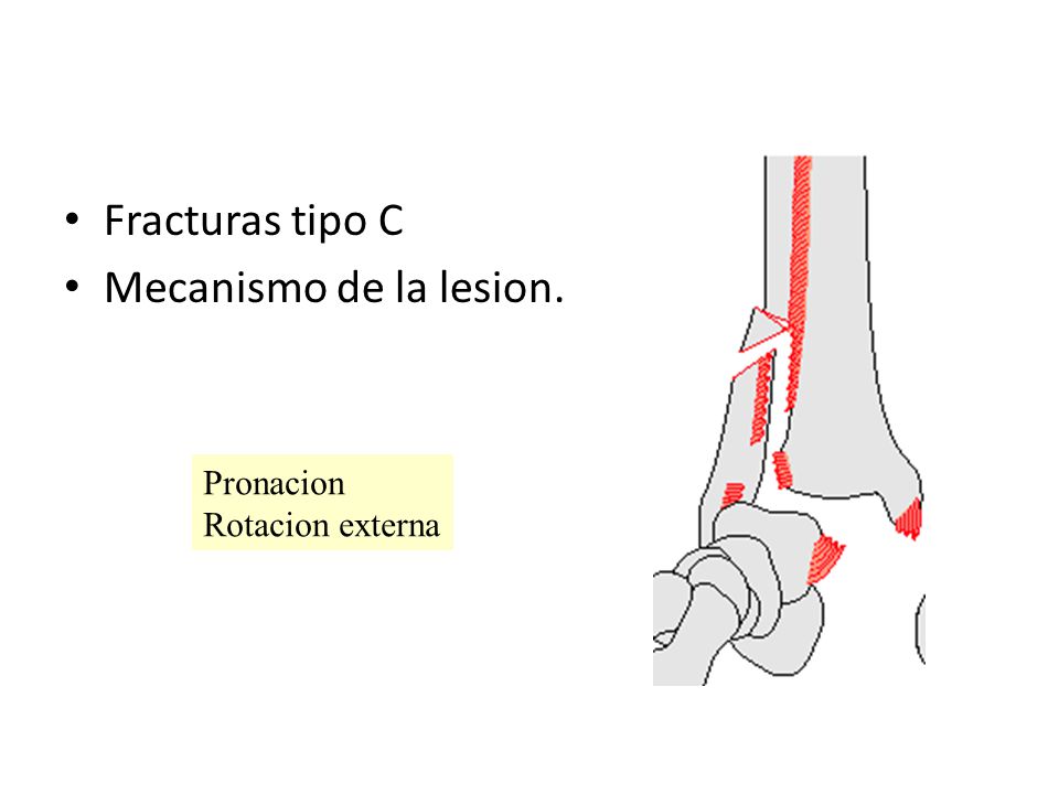 Fracturas tipo C Mecanismo de la lesion. Pronacion Rotacion externa