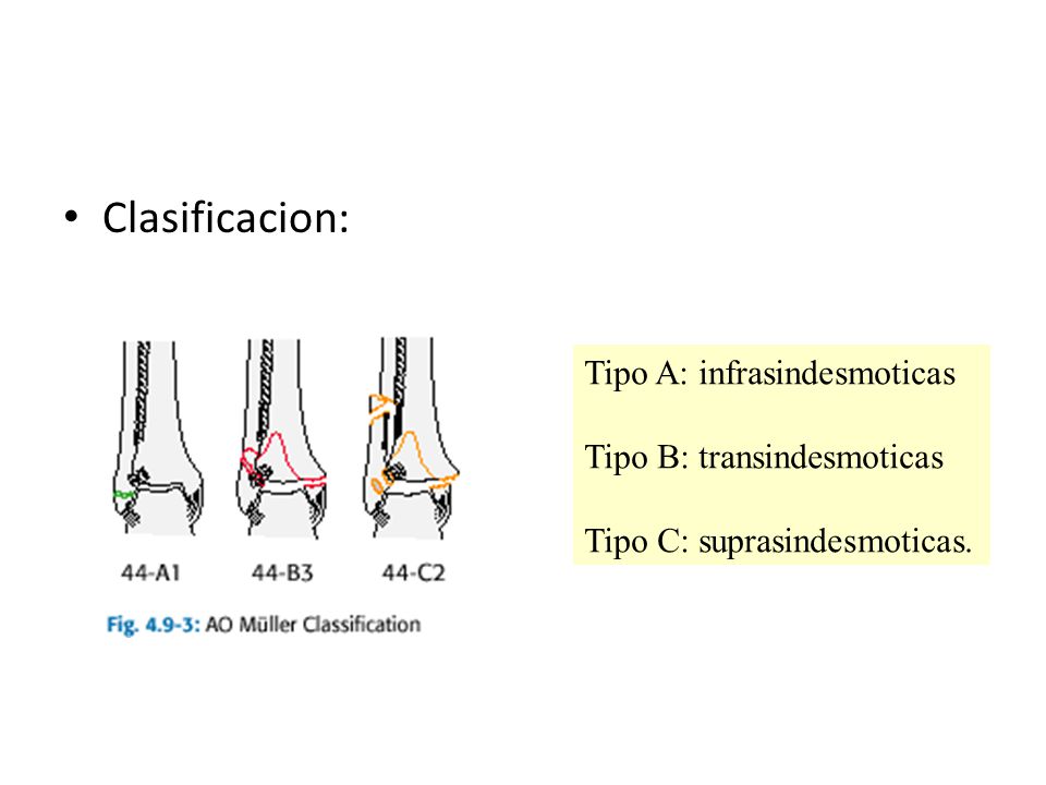 Clasificacion: Tipo A: infrasindesmoticas Tipo B: transindesmoticas