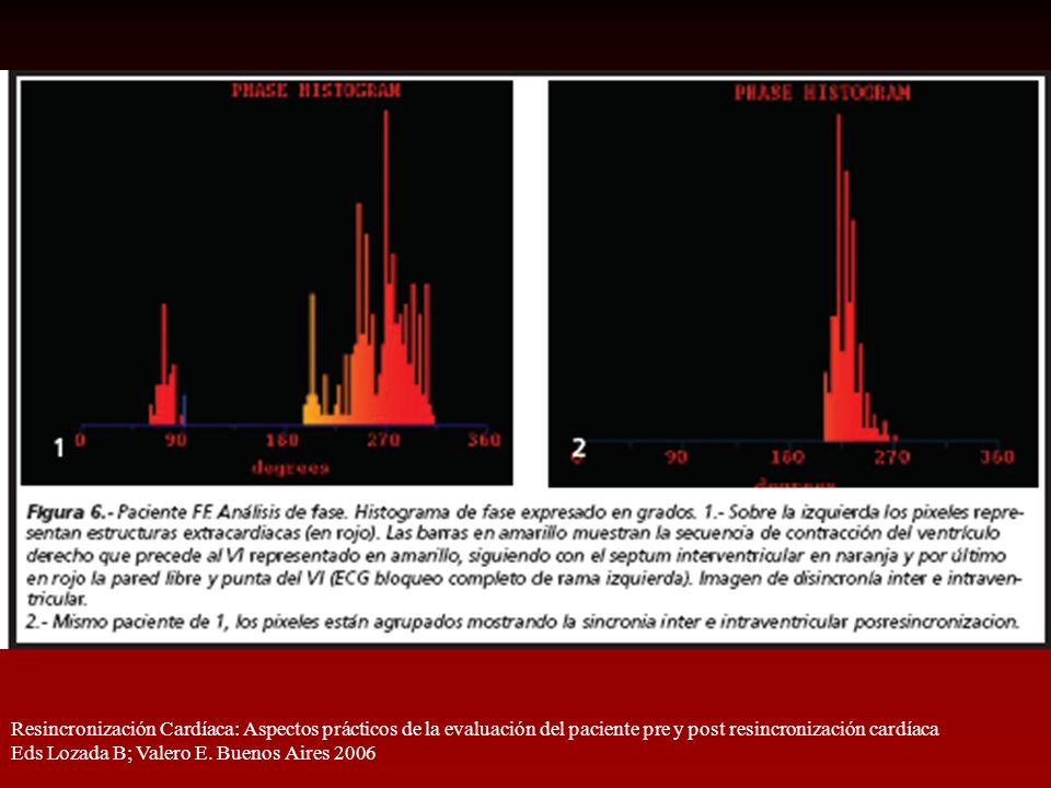 Resincronización Cardíaca: Aspectos prácticos de la evaluación del paciente pre y post resincronización cardíaca