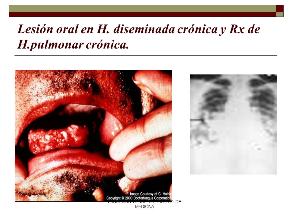 Lesión oral en H. diseminada crónica y Rx de H.pulmonar crónica.