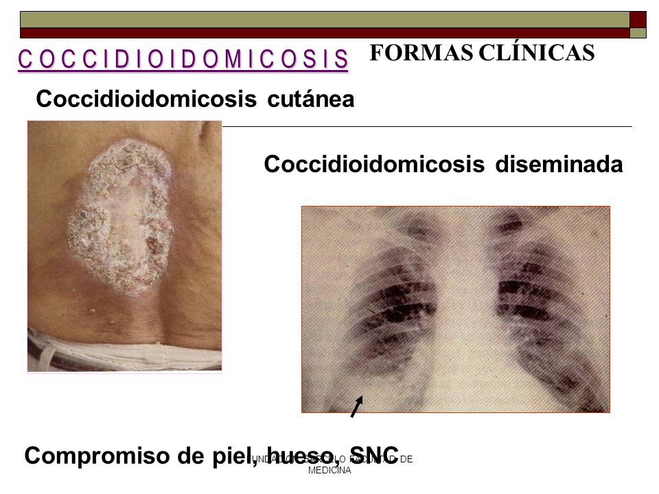 C O C C I D I O I D O M I C O S I S FORMAS CLÍNICAS