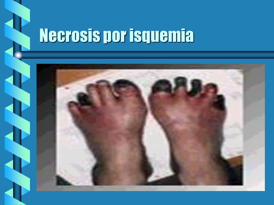 Necrosis por isquemia