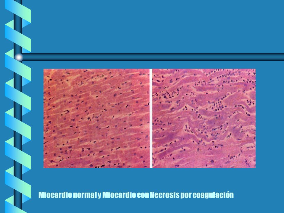 Miocardio normal y Miocardio con Necrosis por coagulación