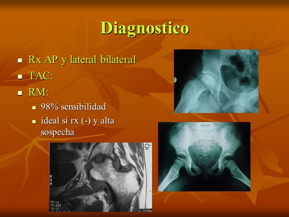 Diagnostico Rx AP y lateral bilateral TAC: RM: 98% sensibilidad