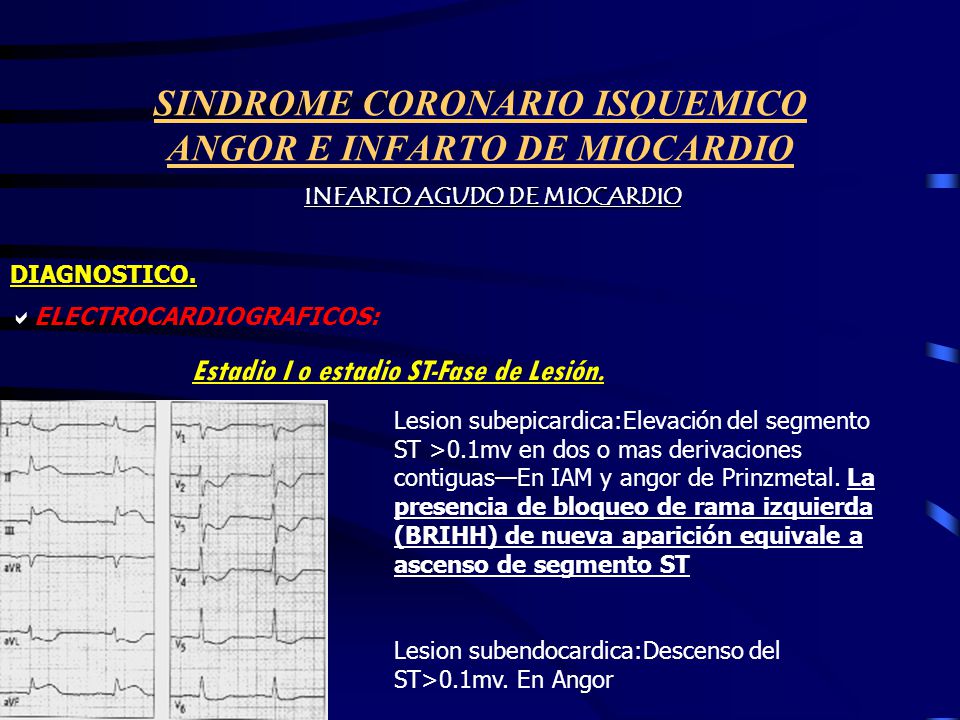 SINDROME CORONARIO ISQUEMICO ANGOR E INFARTO DE MIOCARDIO