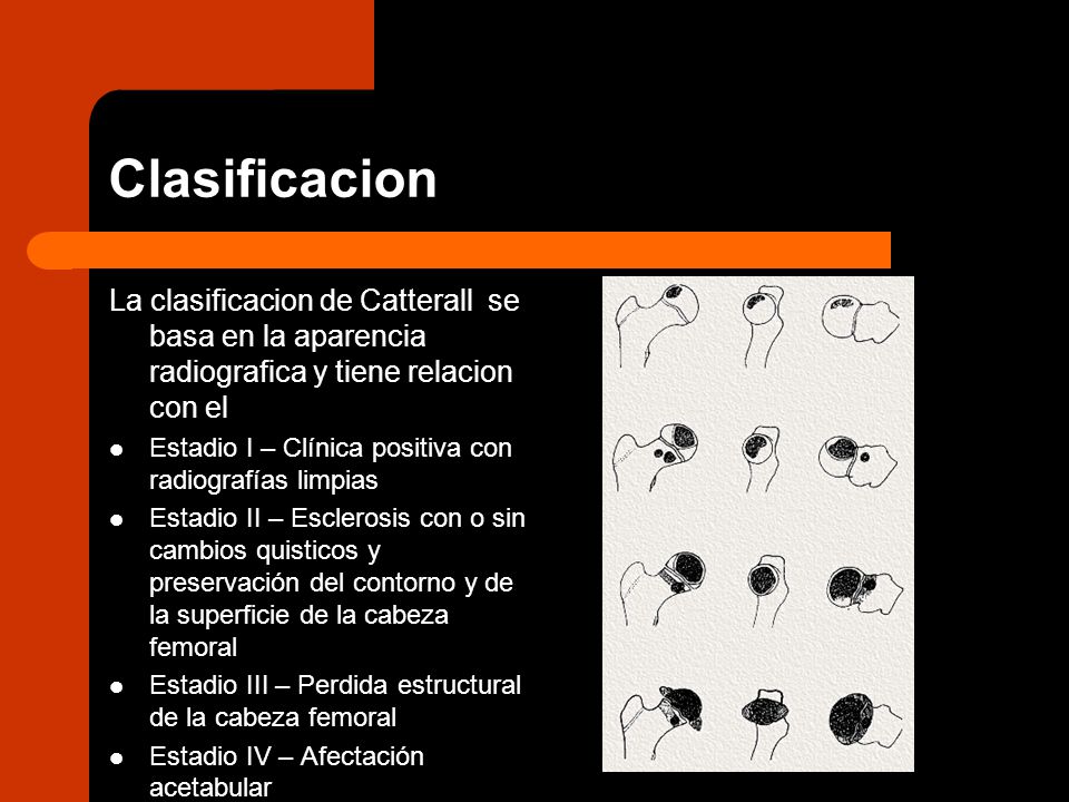 Clasificacion La clasificacion de Catterall se basa en la aparencia radiografica y tiene relacion con el.