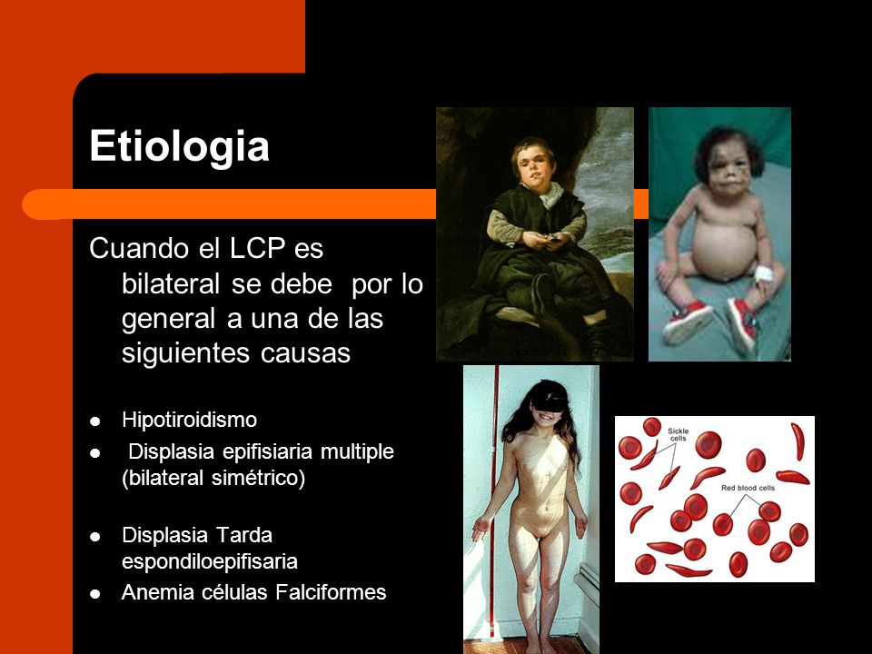 Etiologia Cuando el LCP es bilateral se debe por lo general a una de las siguientes causas. Hipotiroidismo.