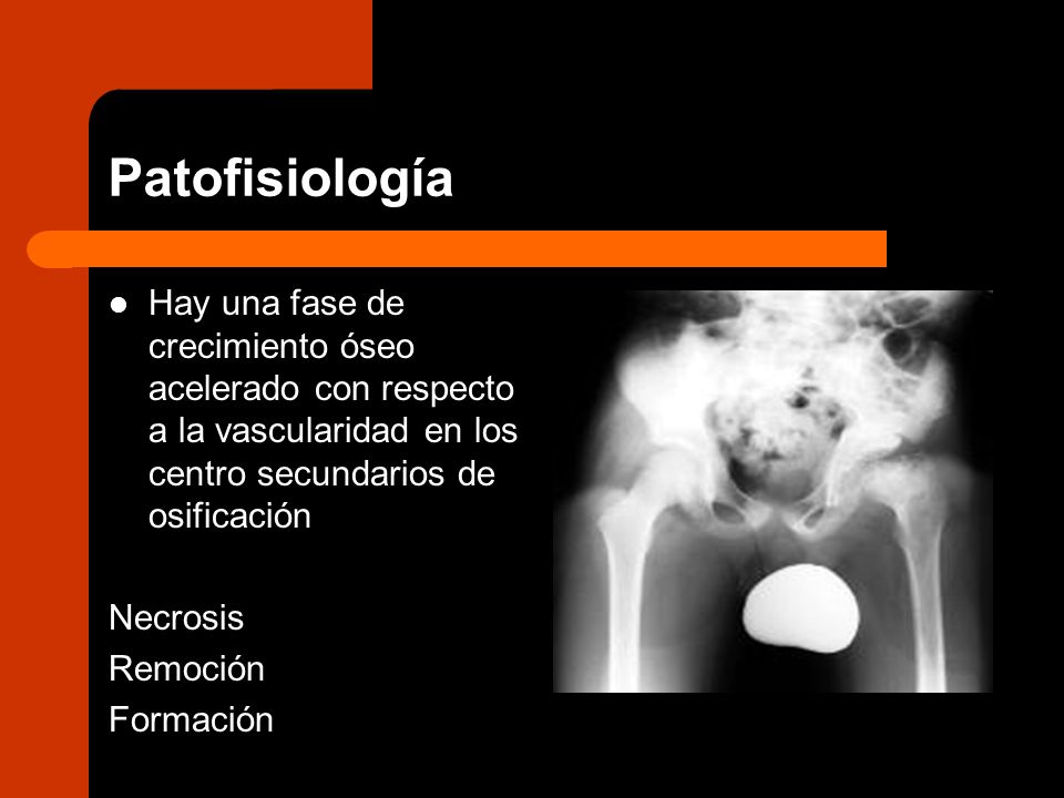 Patofisiología Hay una fase de crecimiento óseo acelerado con respecto a la vascularidad en los centro secundarios de osificación.