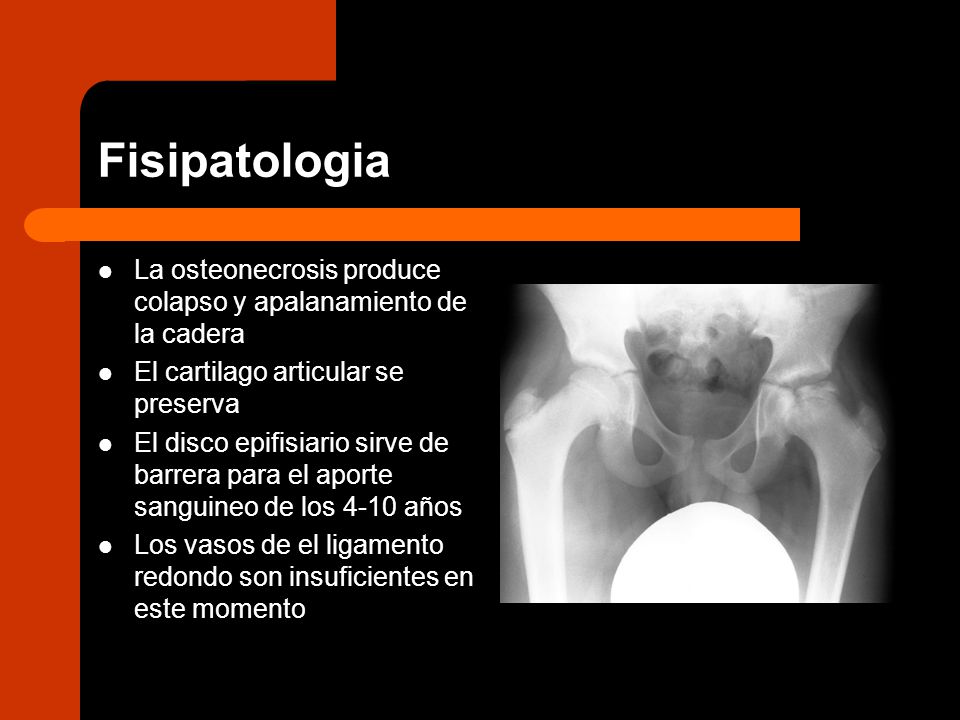 Fisipatologia La osteonecrosis produce colapso y apalanamiento de la cadera. El cartilago articular se preserva.