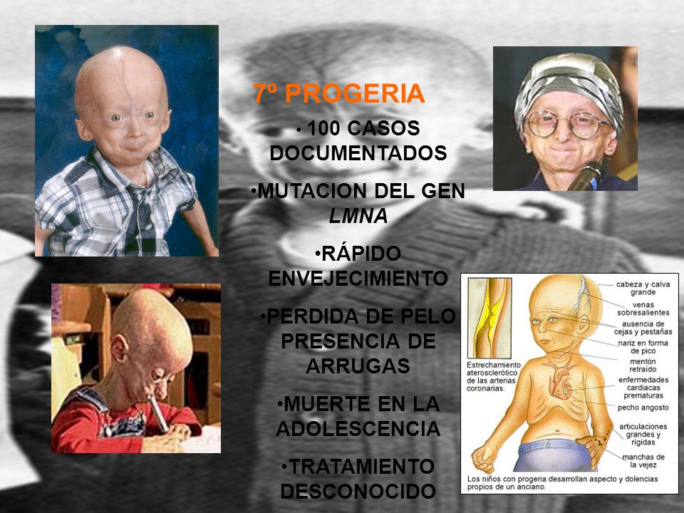 7º PROGERIA MUTACION DEL GEN LMNA RÁPIDO ENVEJECIMIENTO