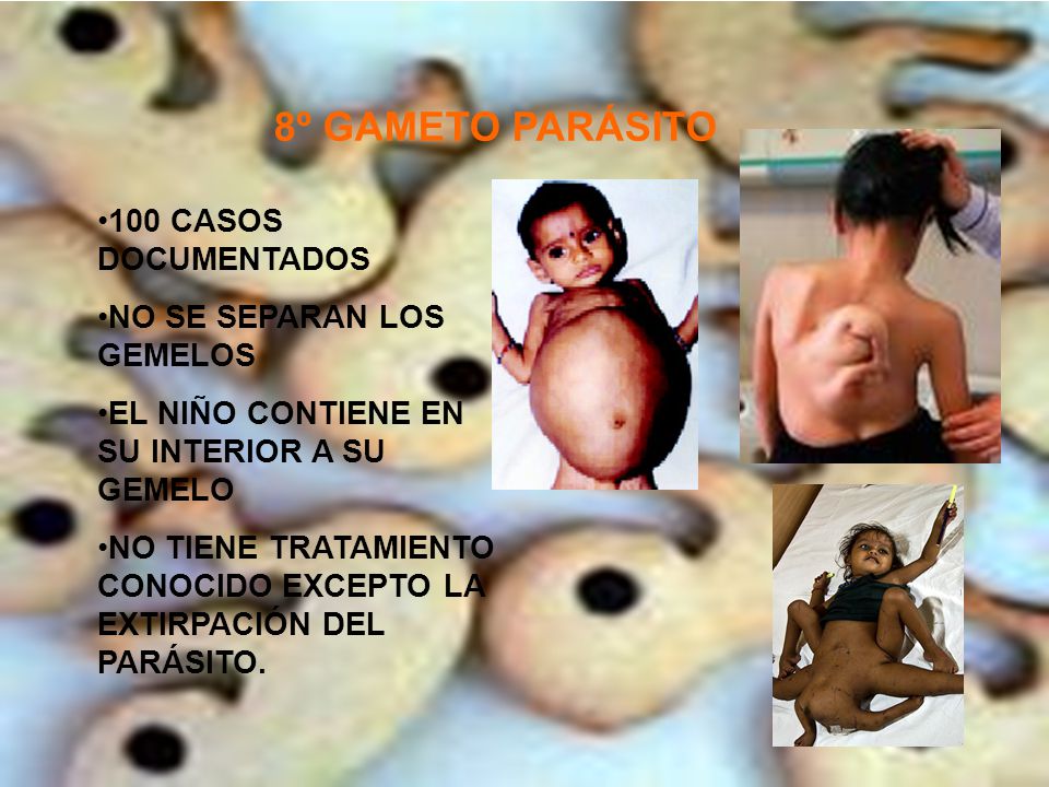8º GAMETO PARÁSITO 100 CASOS DOCUMENTADOS NO SE SEPARAN LOS GEMELOS