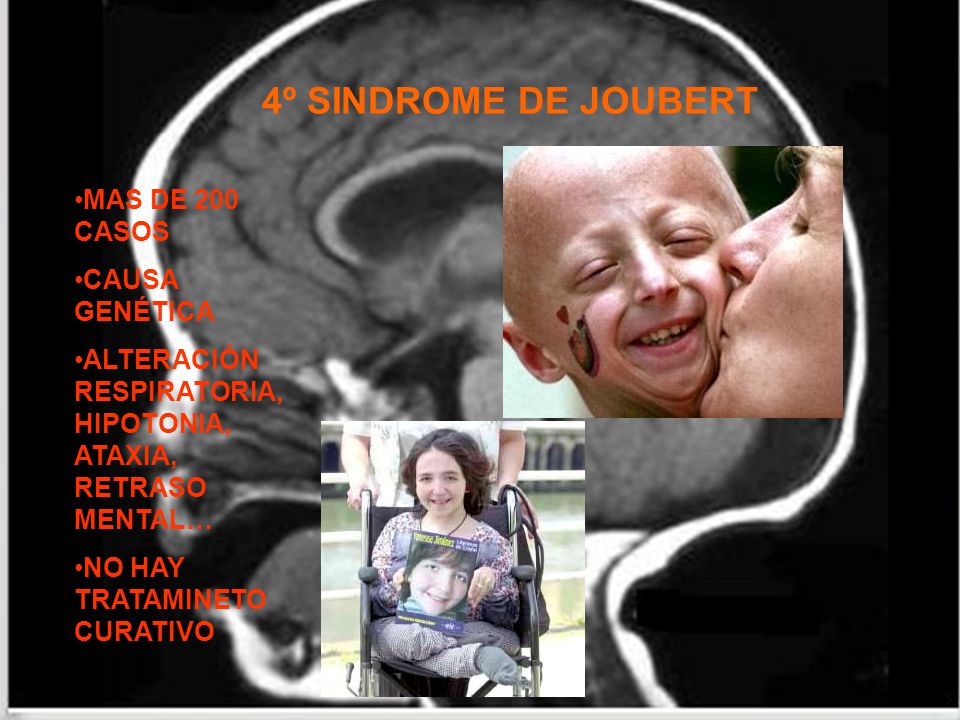 4º SINDROME DE JOUBERT MAS DE 200 CASOS CAUSA GENÉTICA