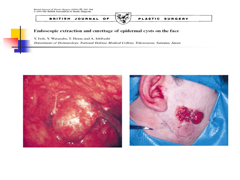 Una incision en meato de CAE cerca del trago para meter el endoscopio y otra incisión retroauricular.