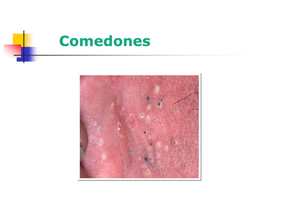 Comedones - Necesidad e quitarlos antes de isotretinoina oral por riesgo de rebrote inflamatorio o incluso acné fulminans.