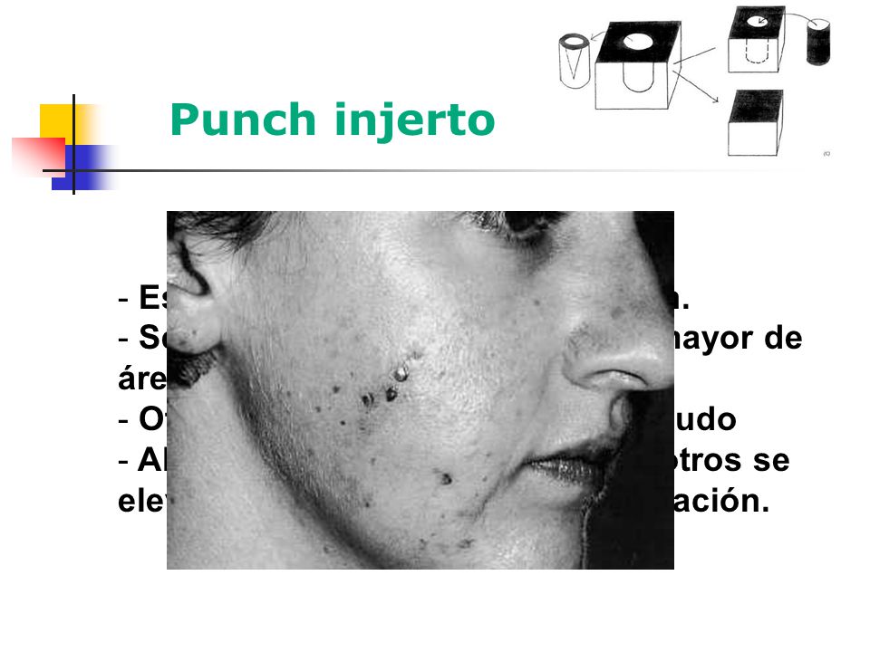 Punch injerto Es la mejor de las técnicas punch.