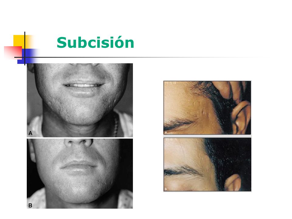 Subcisión Las cicatrices de mentón y labio superior pueden requerir más de una sesión de subcisión.