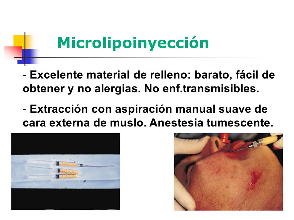 Microlipoinyección Excelente material de relleno: barato, fácil de obtener y no alergias. No enf.transmisibles.