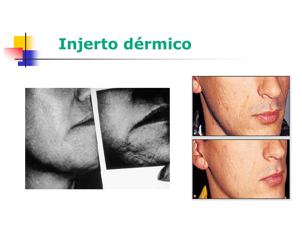 Injerto dérmico 2º: 6 semanas después de resurfacing e injerto dérmico.