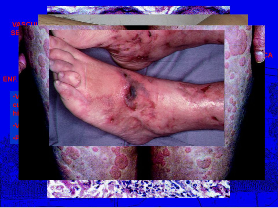 BIOPSIA VASCULITIS SECUNDARIA VASCULITIS PRIMARIA