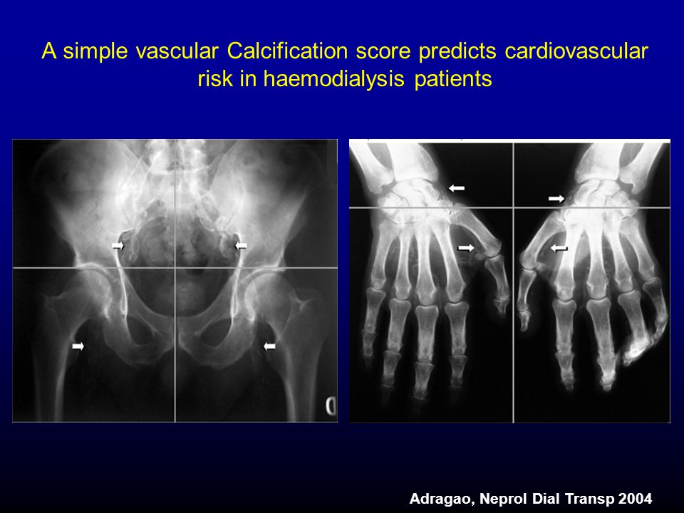 A simple vascular Calcification score predicts cardiovascular risk in haemodialysis patients