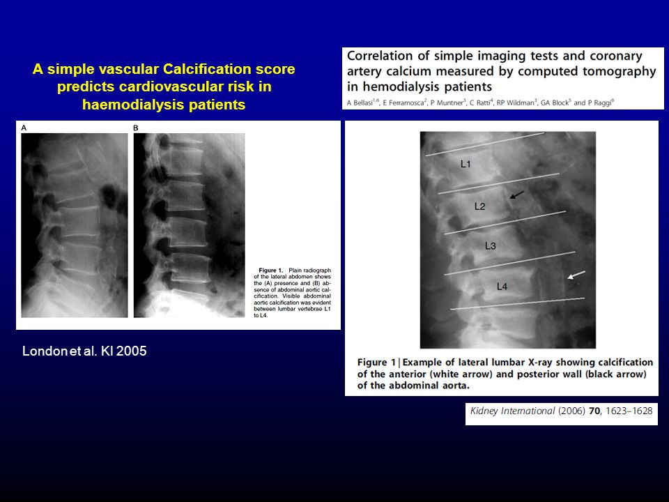 A simple vascular Calcification score predicts cardiovascular risk in haemodialysis patients