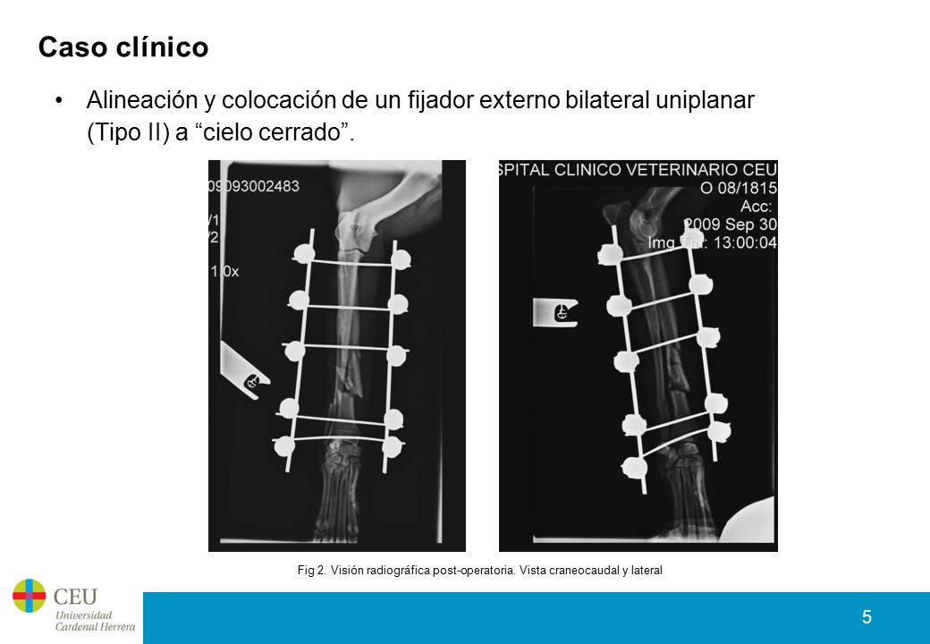 Caso clínico Alineación y colocación de un fijador externo bilateral uniplanar (Tipo II) a cielo cerrado .