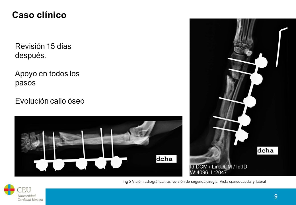 Caso clínico Revisión 15 días después. Apoyo en todos los pasos