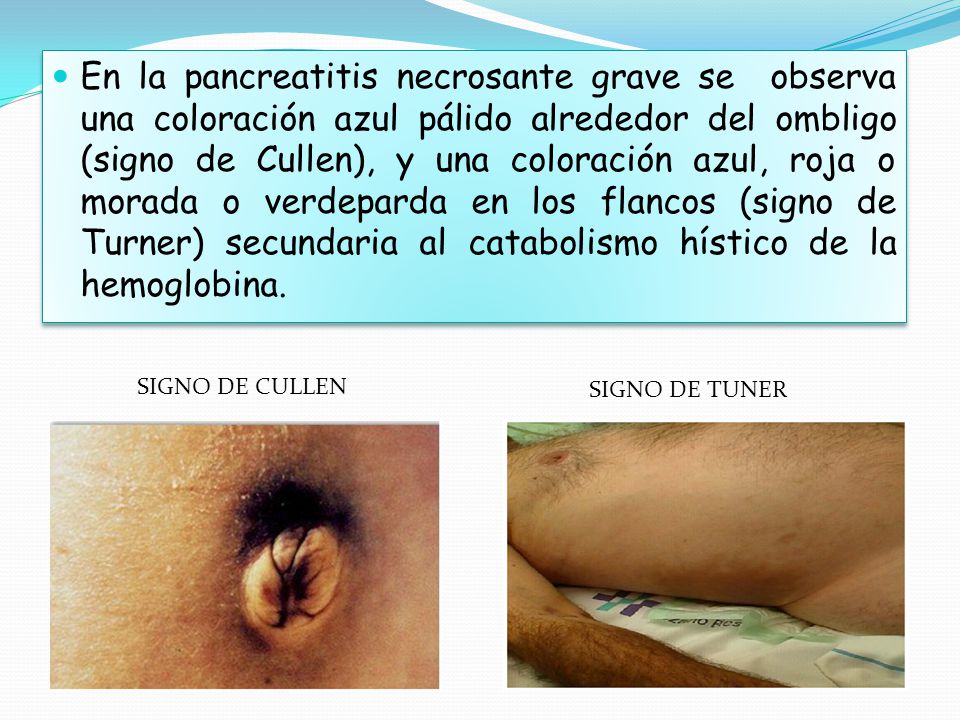 En la pancreatitis necrosante grave se observa una coloración azul pálido alrededor del ombligo (signo de Cullen), y una coloración azul, roja o morada o verdeparda en los flancos (signo de Turner) secundaria al catabolismo hístico de la hemoglobina.