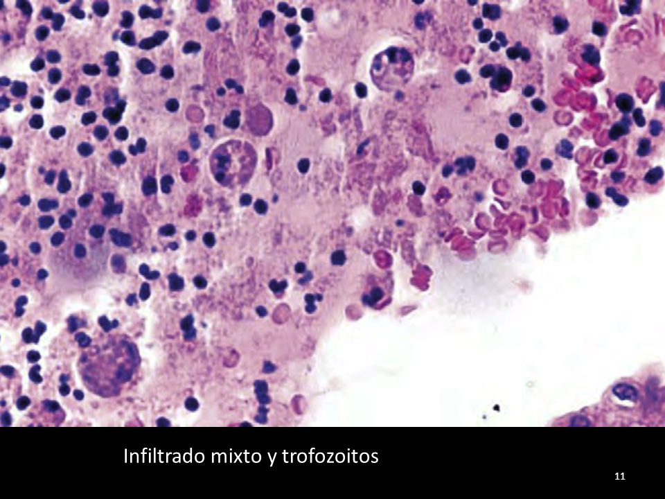 Infiltrado mixto y trofozoitos