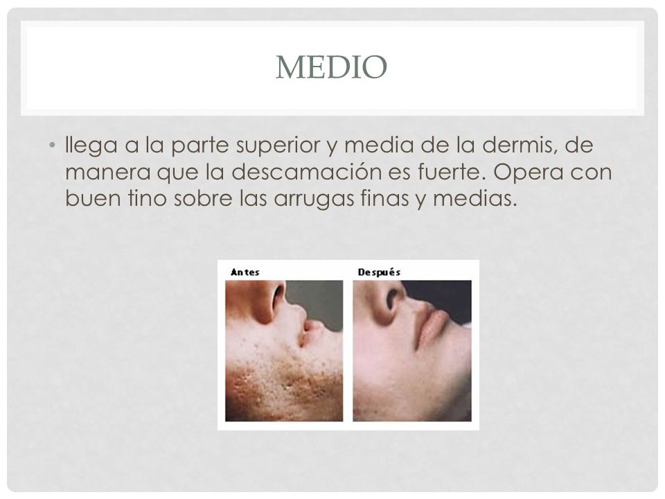 medio llega a la parte superior y media de la dermis, de manera que la descamación es fuerte.