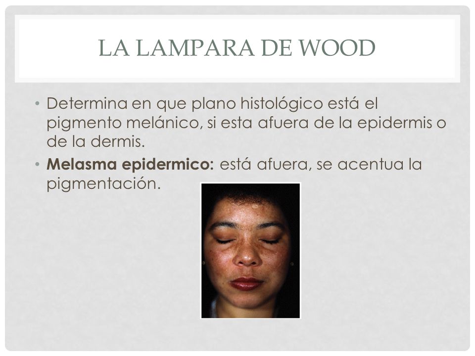 LA LAMPARA DE WOOD Determina en que plano histológico está el pigmento melánico, si esta afuera de la epidermis o de la dermis.