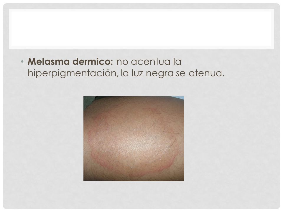 Melasma dermico: no acentua la hiperpigmentación, la luz negra se atenua.