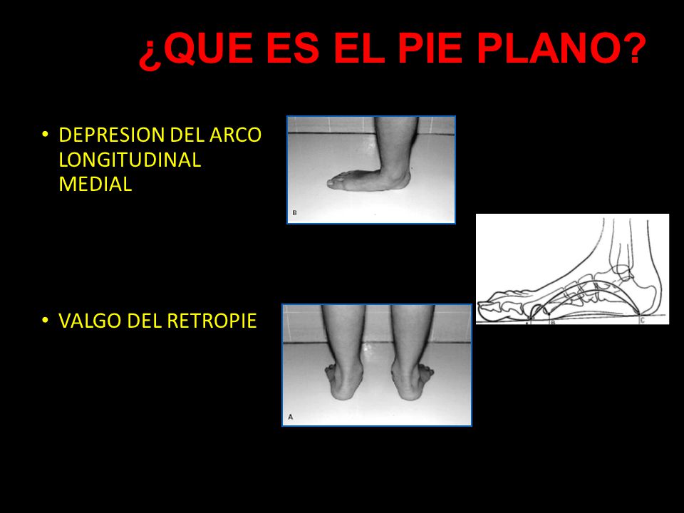 ¿QUE ES EL PIE PLANO DEPRESION DEL ARCO LONGITUDINAL MEDIAL