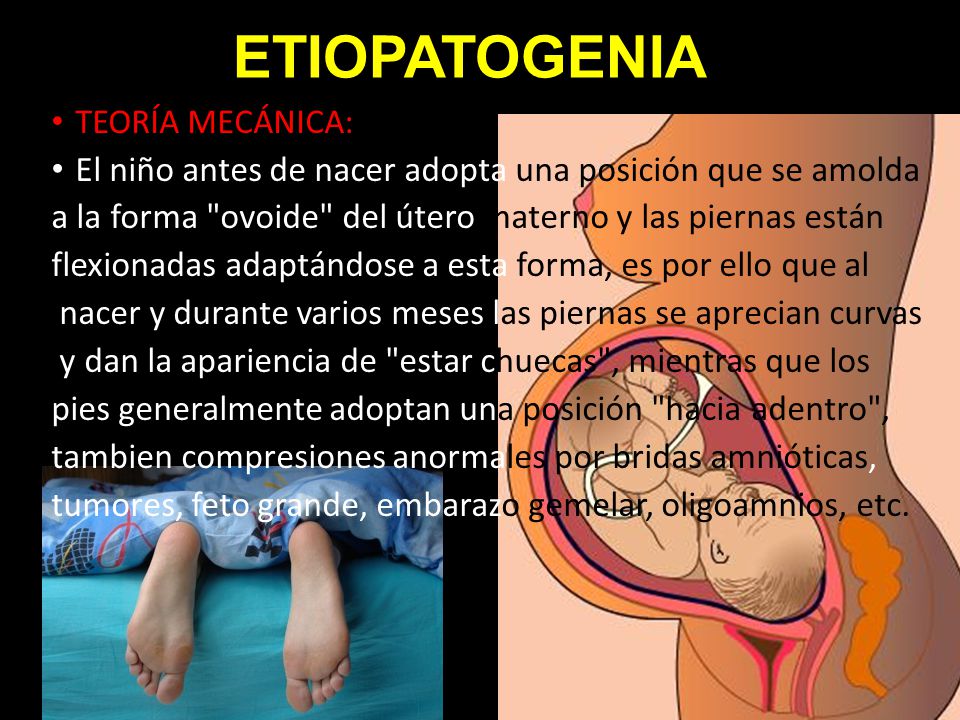 ETIOPATOGENIA El niño antes de nacer adopta una posición que se amolda