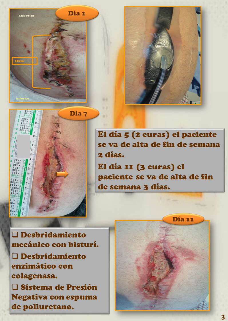 El día 5 (2 curas) el paciente se va de alta de fin de semana 2 días.