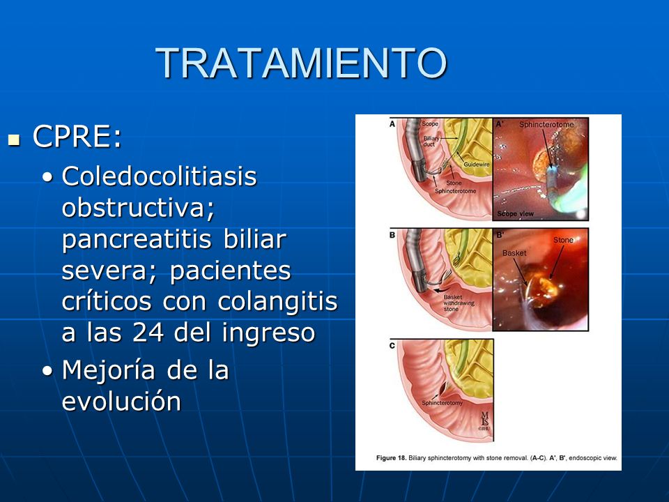 TRATAMIENTO CPRE: Coledocolitiasis obstructiva; pancreatitis biliar severa; pacientes críticos con colangitis a las 24 del ingreso.