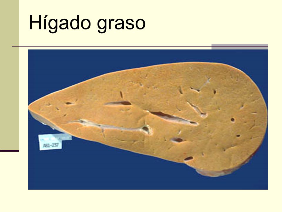 Hígado graso The liver is enlarged, yellow, soft, and greasy, due to accumulation of fat in the hepatocytes, an example of reversible cell injury.
