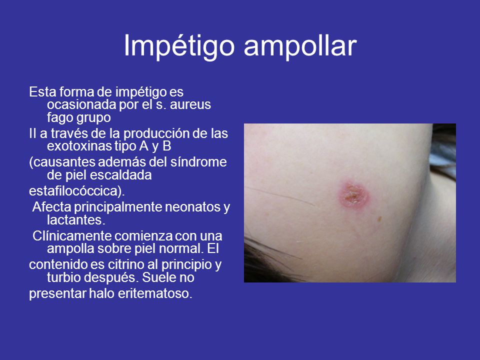Impétigo ampollar Esta forma de impétigo es ocasionada por el s. aureus fago grupo. II a través de la producción de las exotoxinas tipo A y B.
